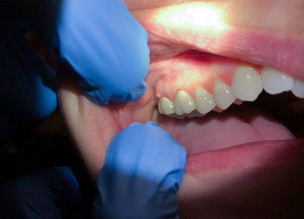 Best Emergency Dental Care for Sports Injuries in Pemberton Heights, NJ